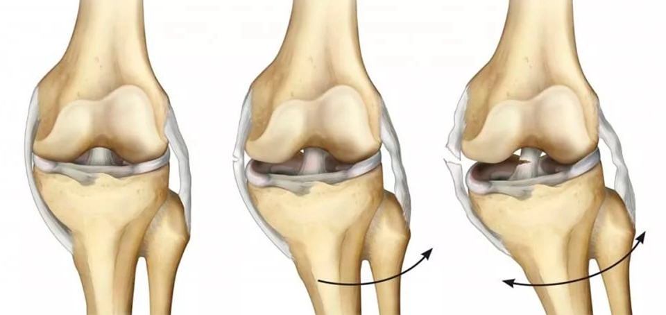 Разрыв сочленений. Задняя крестообразная связка коленного сустава анатомия. Разрыв капсульно связочного аппарата. Разрыв связок ПКС коленного сустава. Разрыв крестообразной связки сустава колена.